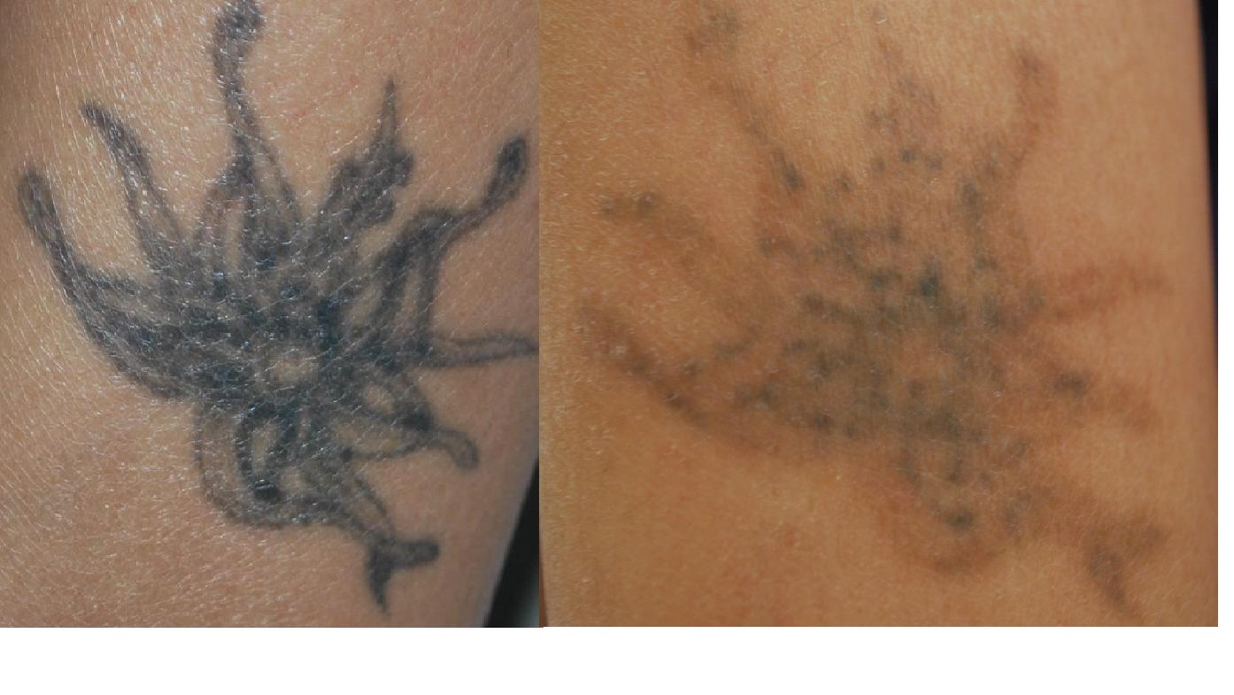 ... : Where to go for a Tattoo Removal in Dubai - my unwanted body design