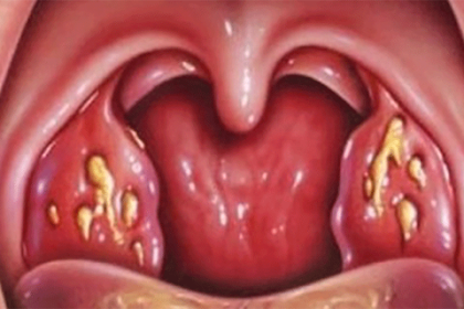How To Get Rid Of Tonsillitis And Sore Throat in Only Few Hours!