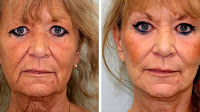Mini Face Lift Before And After Photos