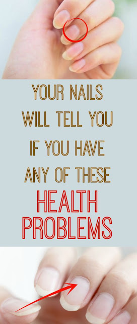 Your Nails Will Tell You If You Have Any Of These Health Problems!