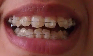 gingivitis with braces, loose teeth, damon braces, braces for teeth, damon clear brackets, white brackets, picture