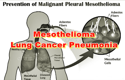 Mesothelioma Lung Cancer Pneumonia
