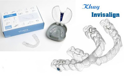 Niềng răng invisalign là gì?