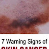 What Skin Cancer Can Look Like : What Do Cancerous Moles Look Like? - HTQ / Arising from melanocytes, melanoma can look like a mole and some develop within an existing mole.
