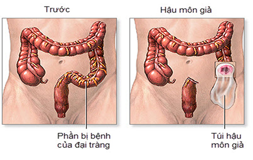 Hậu môn nhân tạo là gì và cách chăm sóc