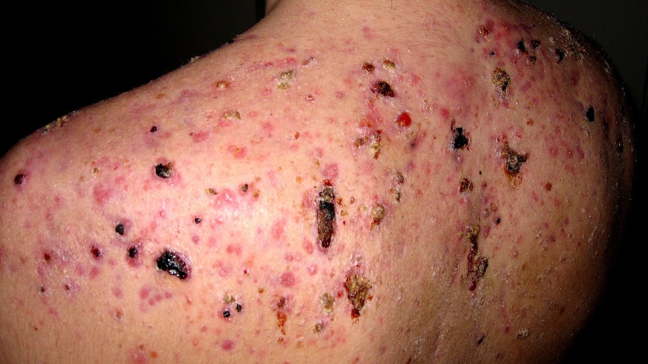 How To Get Rid Of Body Acne Fast