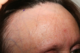 Alopecia Fibrosante Frontal parte II