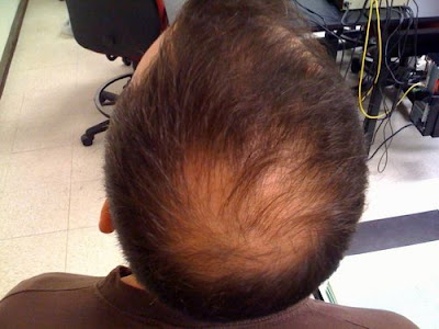 Hairloss 