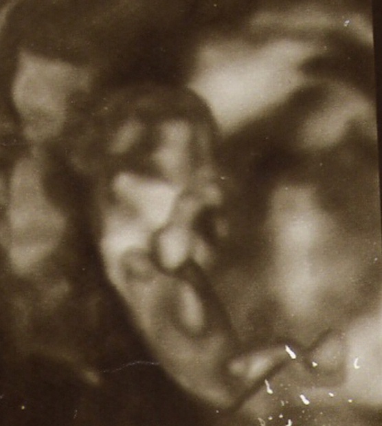 12 5 week ultrasound. 12 5 week ultrasound.