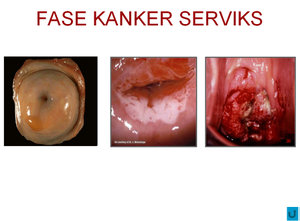  KANKER  SERVIKS  Dunia Ku