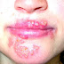 Herpes simplex