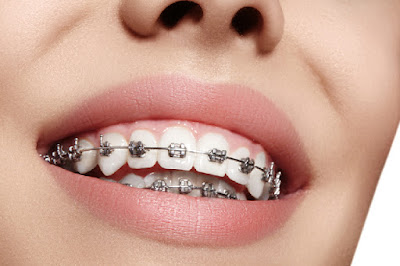 Chi phí niềng răng hô với từng phương pháp 3