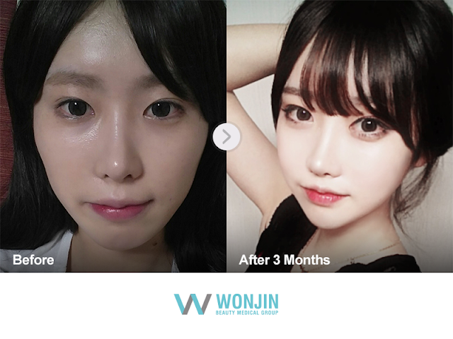 Korean plastic surgery review