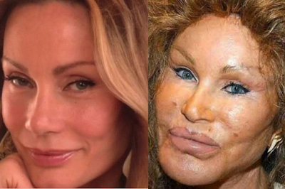 Celebrities Who Have Ruined Their Faces Due to Plastic Surgery