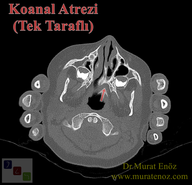 Koanal atrezi nedir? - Koanal atrezi tarihçesi - Koanal atrezi çeşitleri - Bilateral (iki taraflı) koanal atrezi - Tek taraflı koanal atrezi - Koanal atrezi belirtileri - İki taraflı koanal atrezi belirtileri - Tek taraflı koanal atrezi belirtileri - Koanal atrezi neden olur? - Koanal atrezi nedenleri - Koanal atrezi nasıl teşhis edilir? - Koanal atrezi tanısı - Koanal atrezi tedavisi - Koanal atrezi ameliyatı nasıl yapılır? - Koanal atrezi ameliyatı sonrası - Koanal atrezi hemşirelik bakımı - Koanal atrezi emziği (McGovern Emziği - McGovern Nipel) hakkında - Tekrarlayan koanal atrezi