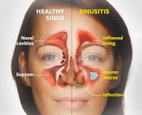 penyakit sinusitis