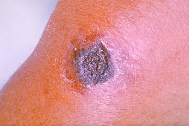 Expert Calls for Animal Disease Screening to Prevent Anthrax Spread
