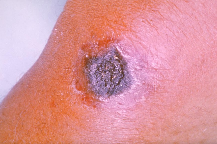 Expert Calls for Animal Disease Screening to Prevent Anthrax Spread