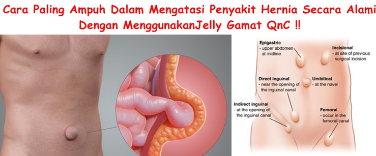 Obat Tradisional Hernia Tanpa Operasi