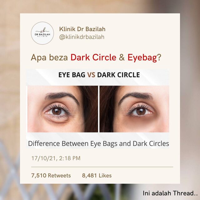 Beza Eyebag dan dark circle