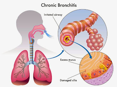 Naturally clean the bronchial tubes