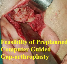 Case studies in Oral Health Science, Case studies in ENT, Case Report in ENT, Gap-arthroplasty of Tempromandibular Joint Ankylosis, Feasibilty of Preplanned Computer Guided Gap-arthroplasty, Case Report in Maxillofacial Surgery 