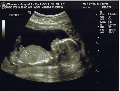 Baby Ultrasound Pictures on 18 Week Baby Girl Ultrasound Babies   Littlebabypictures Com