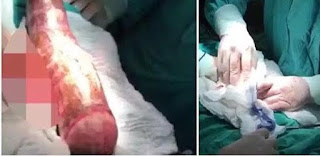 Doctors remove 18 inches cassava from a man who was using it as sex toy (Photos)