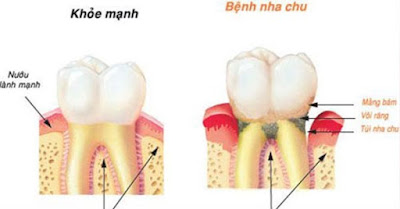 Nguyên nhân gây bệnh viêm nha chu 