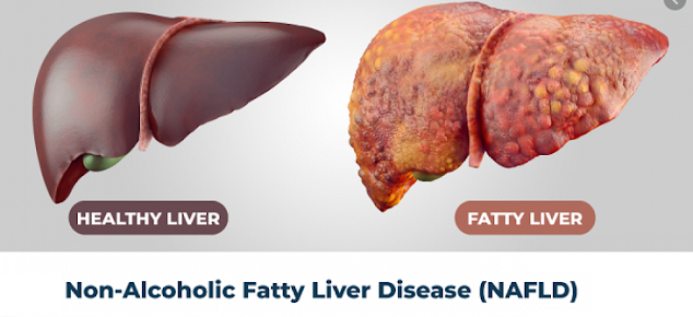 Fatty Liver