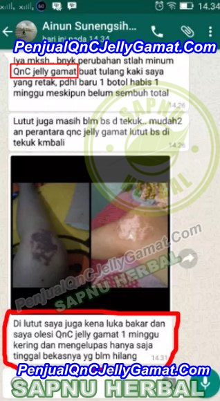 Cara Cepat Mengobati Luka Bakar Tanpa Membekas