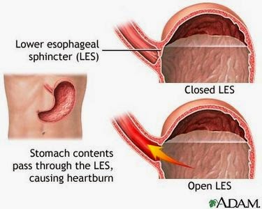 Regarding Acid Reflux, We Have The Goods