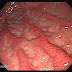 Errores al combatir la gastritis