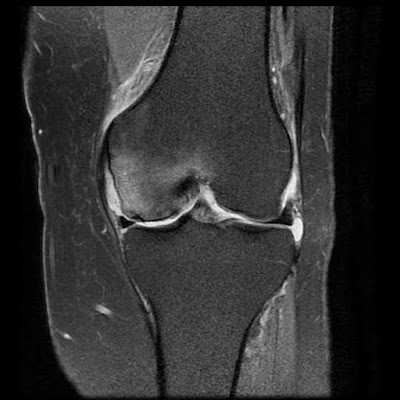 Kangaroo Search - image - septic arthritis knee