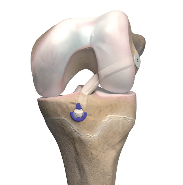 Anterior Cruciate Ligament and Posterior Cruciate Ligament Reconstruction Devices Market