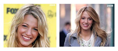 Blake Lively Nose Job