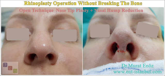 Nose Job Without Bone Broken, Rhinoplasty Without Breaking The Nasal Bone in Istanbul