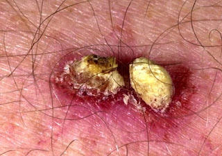 skin cancer squamous cell carcinoma
