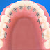 Niềng răng trong loại bỏ các vấn đề khiếm khuyết răng hiệu quả