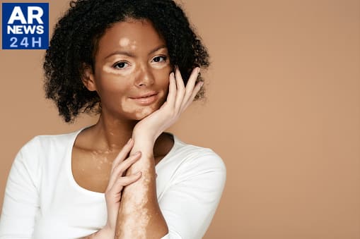 FDA aprova creme de ruxolitinibe para vitiligo