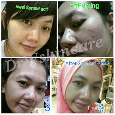 Paket acne drw skincare