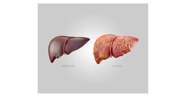 Liver Disease:परिभाषा, लिवर रोग के प्रकार और रोकथाम के उपाय