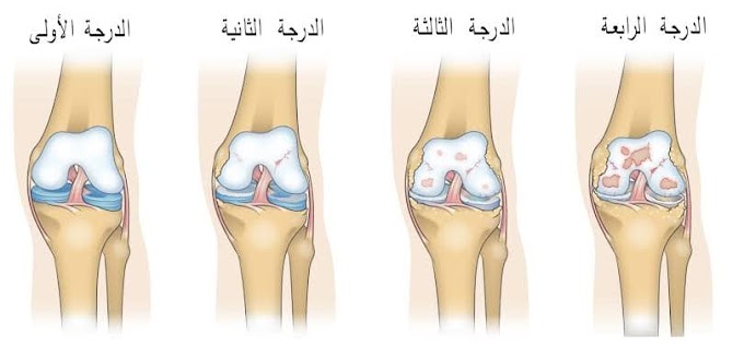  علاج خشونة الركبة