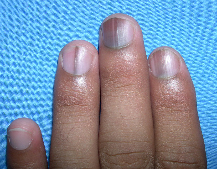 Vertical Lines in Nails Vitamin Deficiency