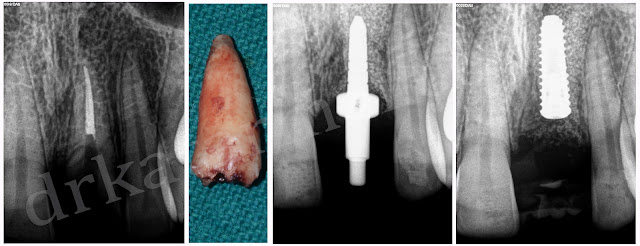 X-Rays for Steps of Dental Implant Procedures at Jamnagar