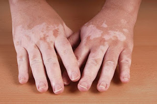 Obat penyakit vitiligo