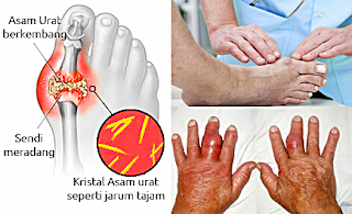 GEJALA DAN CARA MENGOBATI ASAM URAT DENGAN OBAT HERBAL