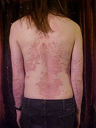 red scally patches of skin caused by psoriasis