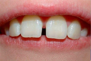 Trám thẩm mỹ răng thưa thực hiện theo kỹ thuật nào?