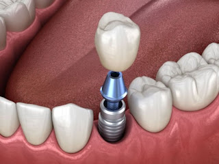 Giá trồng răng implant-2